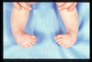 Club foot anterior view