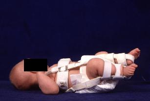 Pavlik harness